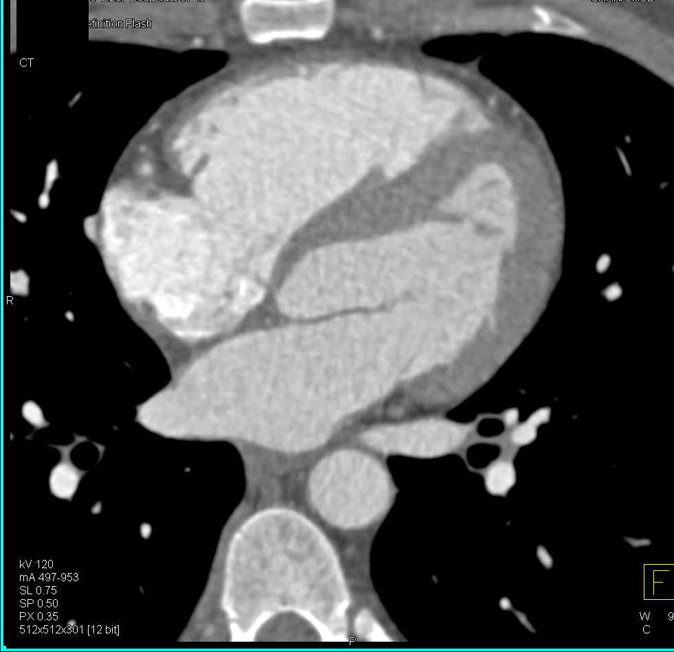 CCTA: Left Anterior Descending Artery (LAD) Arises from the Right Cusp - CTisus CT Scan