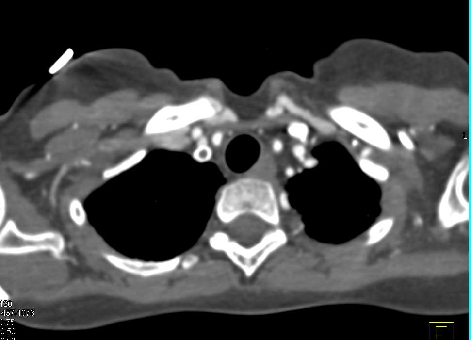 Thrombi Left Ventricle with Multiple Emboli Distantly - Cardiac Case ...