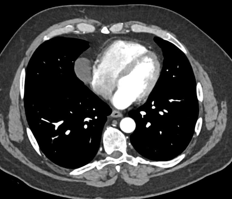 Pericardial Cyst - CTisus CT Scan