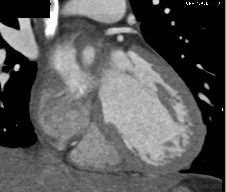 Normal Coronary Artery Anatomy - CTisus CT Scan