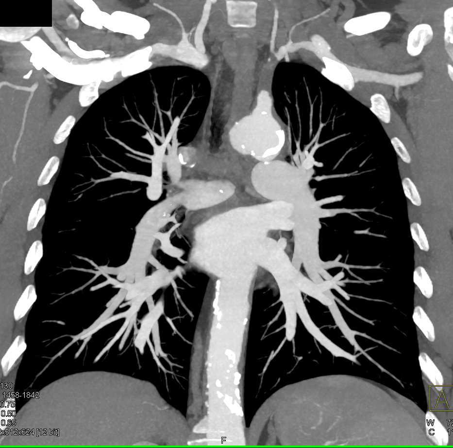 Takayasu's Involving Left Carotid and Subclavian Artery - CTisus CT Scan