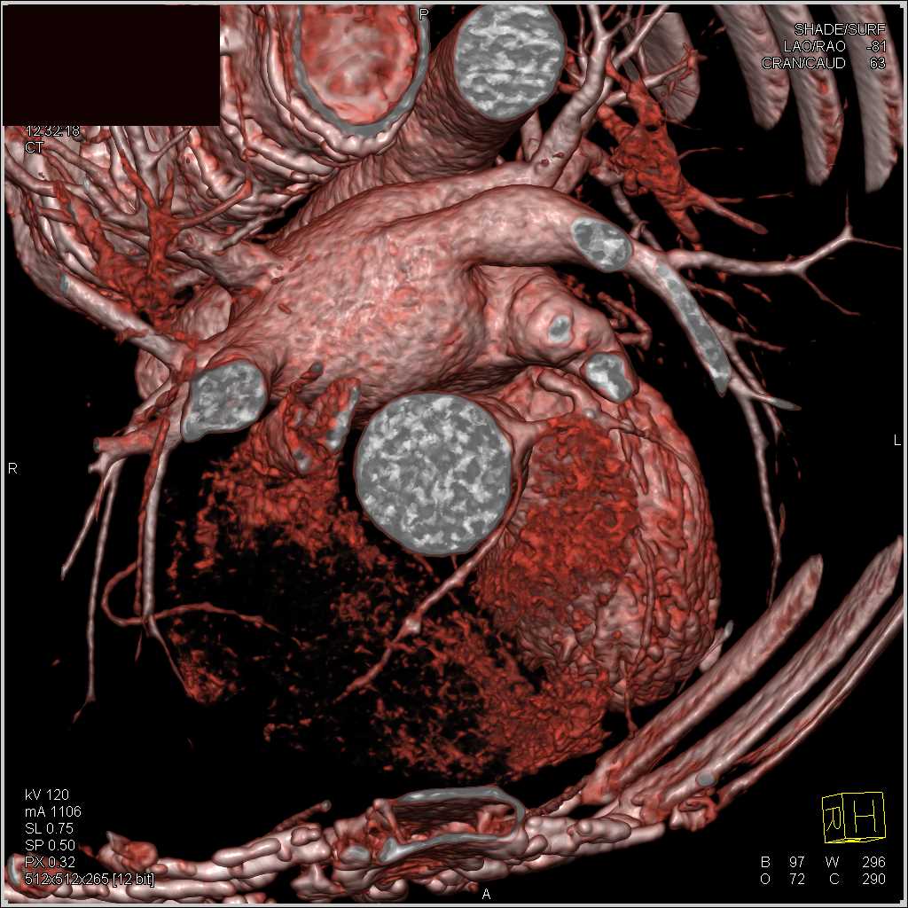 CCTA: Right Coronary Artery (RCA) Arises off the Left Cusp - CTisus CT Scan