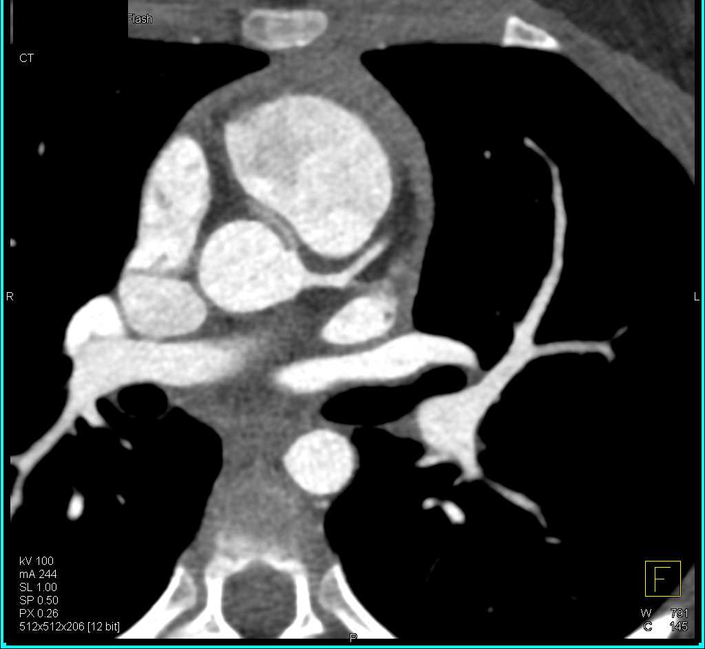 Right Coronary Artery (RCA) Arises off the Left Cusp in a Malignant Configuration - CTisus CT Scan