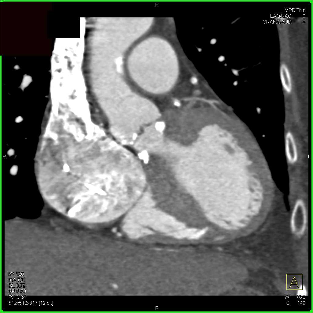 Aortic Valve Calcification and Aortic Stenosis - CTisus CT Scan