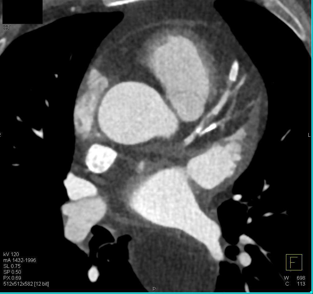 High Grade Stenosis in the Left Anterior Descending Artery (LAD) - CTisus CT Scan