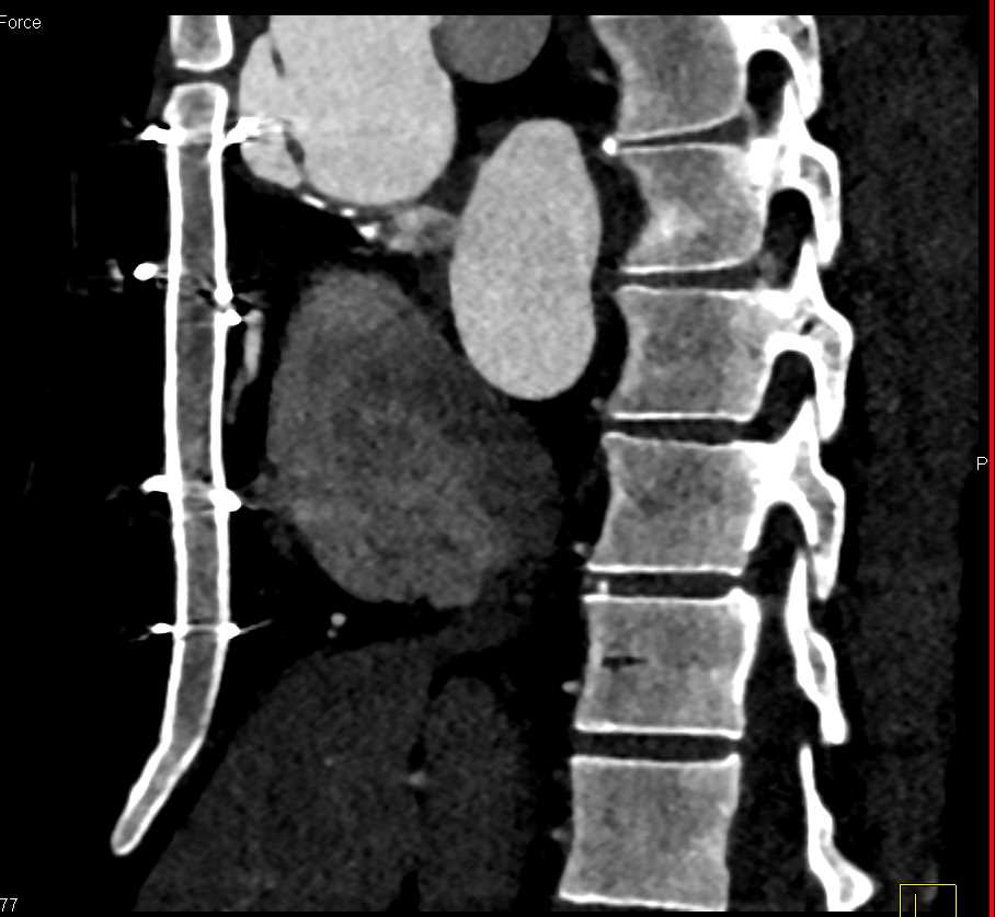 Right Coronary Artery Bypass Graft - CTisus CT Scan