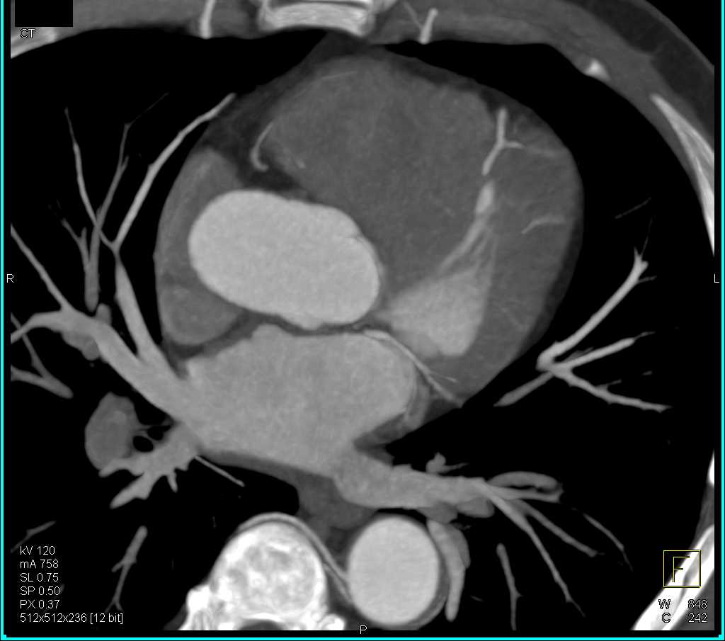 CCTA with Circumflex Arising off the Right Coronary Artery - CTisus CT Scan