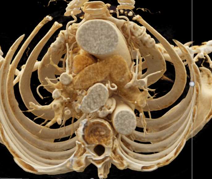 Bronchial Artery Aneurysms - CTisus CT Scan