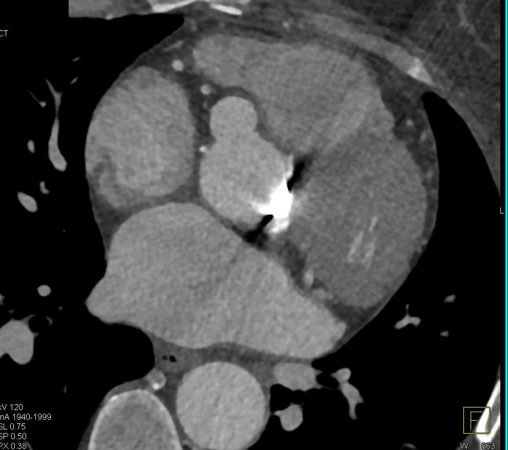 Aneurysmal Dilatation of the Reimplanted Coronary Arteries - CTisus CT Scan