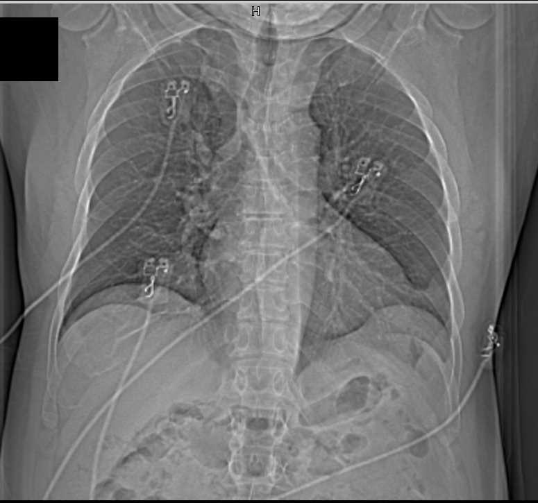 Pericardial Cyst - CTisus CT Scan