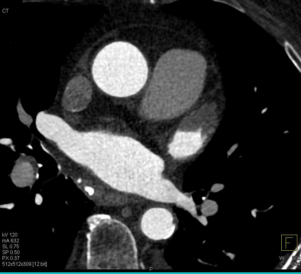 Pseudothrombus in the Left Atrial Appendage - CTisus CT Scan