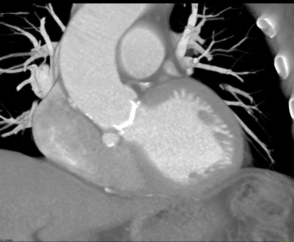 Aortic Valve Replacement (AVR) with Clot on Valve Leaflets - CTisus CT Scan