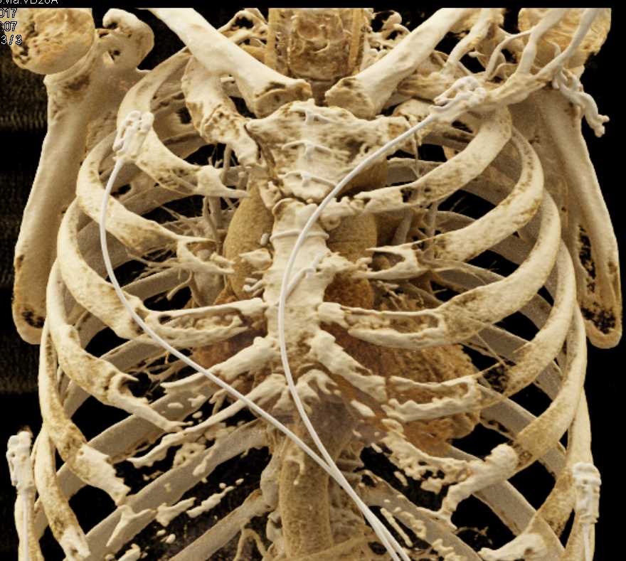 Aortic Valve Replacement (AVR) with Clot on Valve Leaflets with Cinematic Rendering - CTisus CT Scan