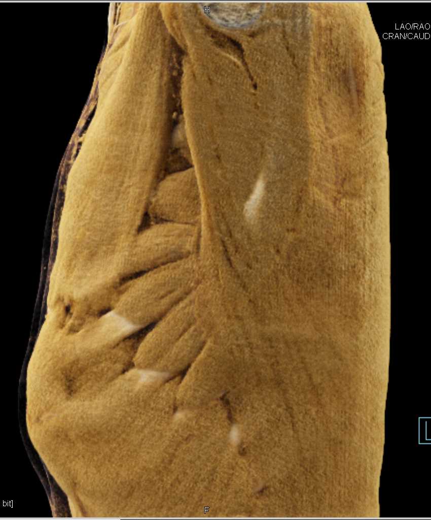 Endovascular Stent Aorta from Coarctation of the Aorta (COA) Repair - CTisus CT Scan