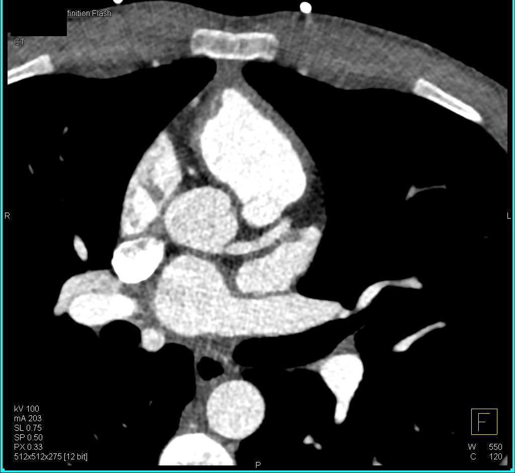 Right Coronary Artery Arises off the Left Cusp - CTisus CT Scan