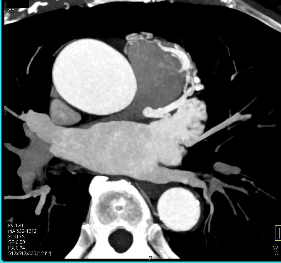 Coronary Artery Fistulae to the Pulmonary Artery - CTisus CT Scan