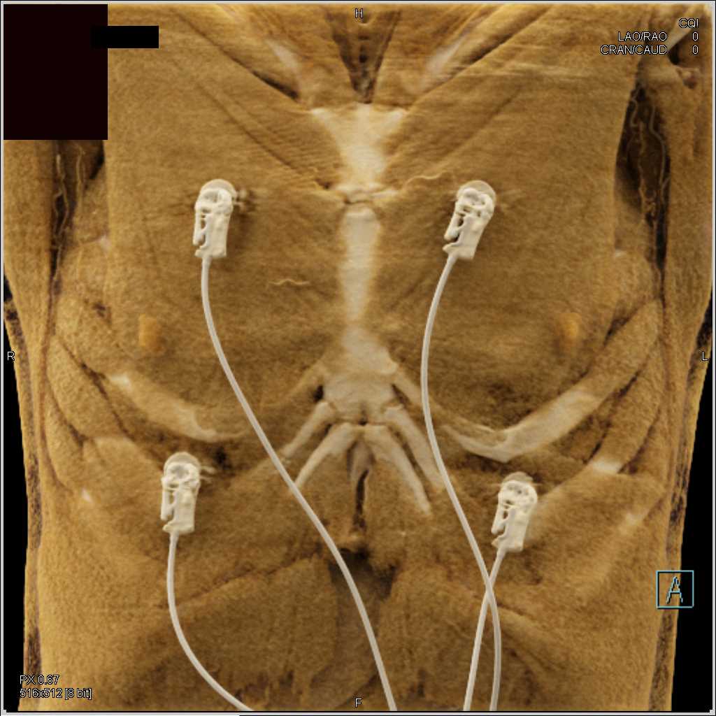 Coronary Artery Fistulae to the Pulmonary Artery - CTisus CT Scan