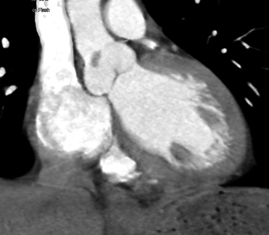Papillary Fibroelastoma off the Aortic Valve - CTisus CT Scan
