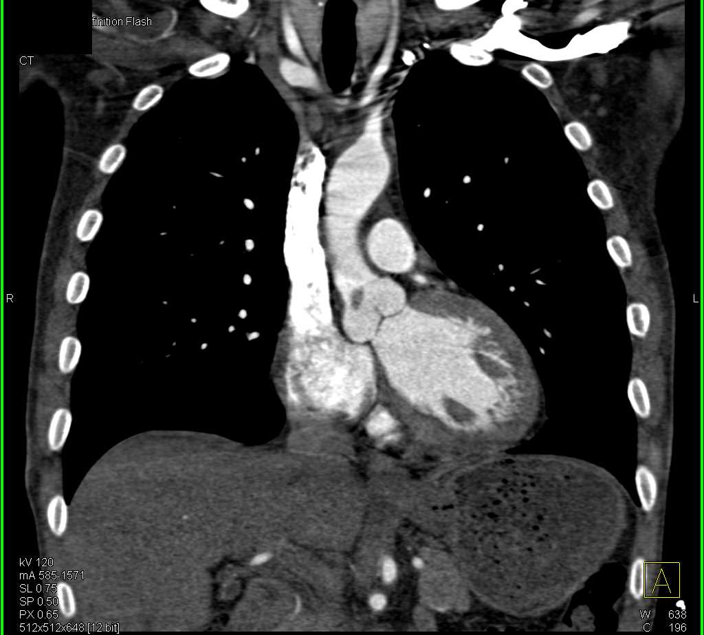 Papillary Fibroelastoma off the Aortic Valve - CTisus CT Scan