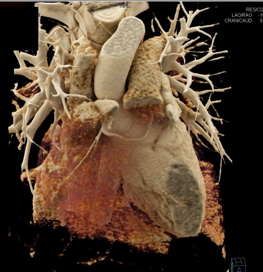 Anomalous Coronary Artery and Normal Left Atrial Appendage - CTisus CT Scan