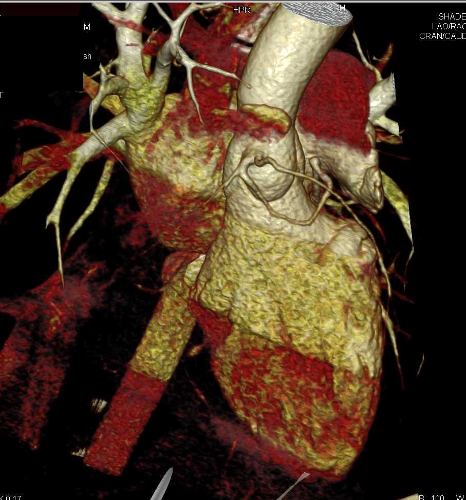 Anomalous Coronary Artery and Normal Left Atrial Appendage - CTisus CT Scan