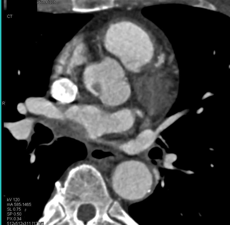 Papillary Fibroelastoma Aortic Valve - CTisus CT Scan