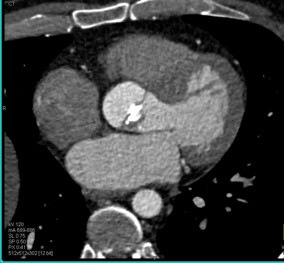 Bicuspid Aortic Valve and Dilated Ascending Aorta - CTisus CT Scan