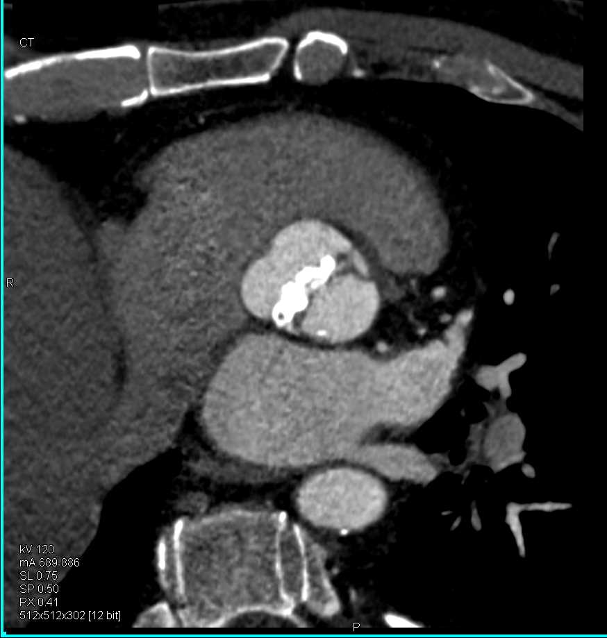 Bicuspid Aortic Valve and Dilated Ascending Aorta - CTisus CT Scan