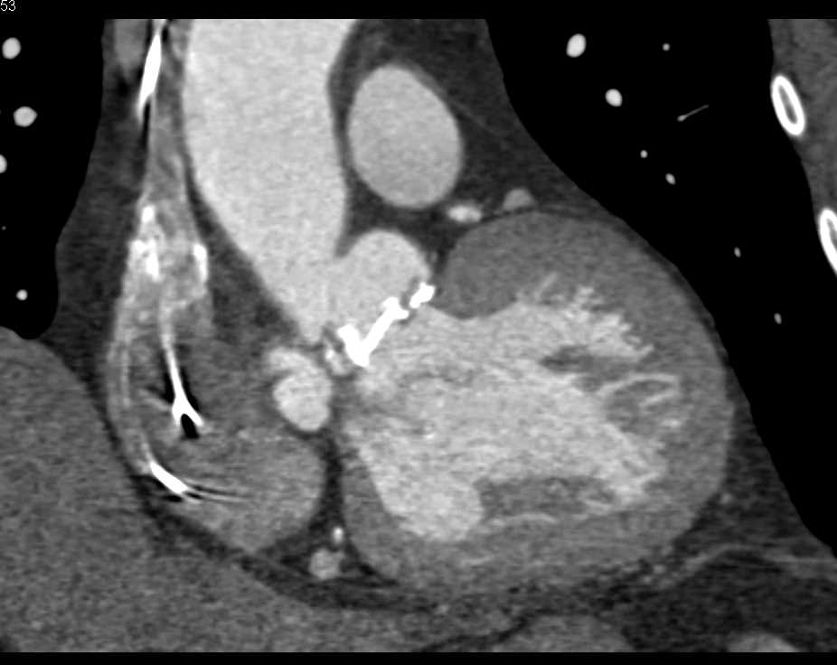 Outpouching Aortic Root near Aortic Valve Replacement (AVR) - CTisus CT Scan