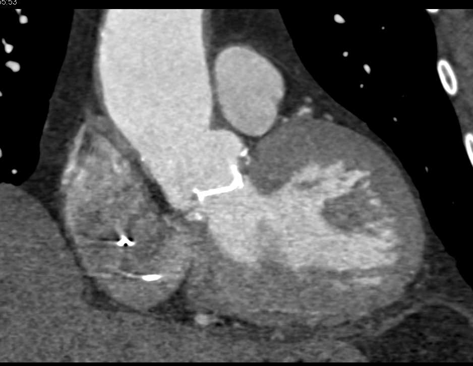 Outpouching Aortic Root near AVR - CTisus CT Scan