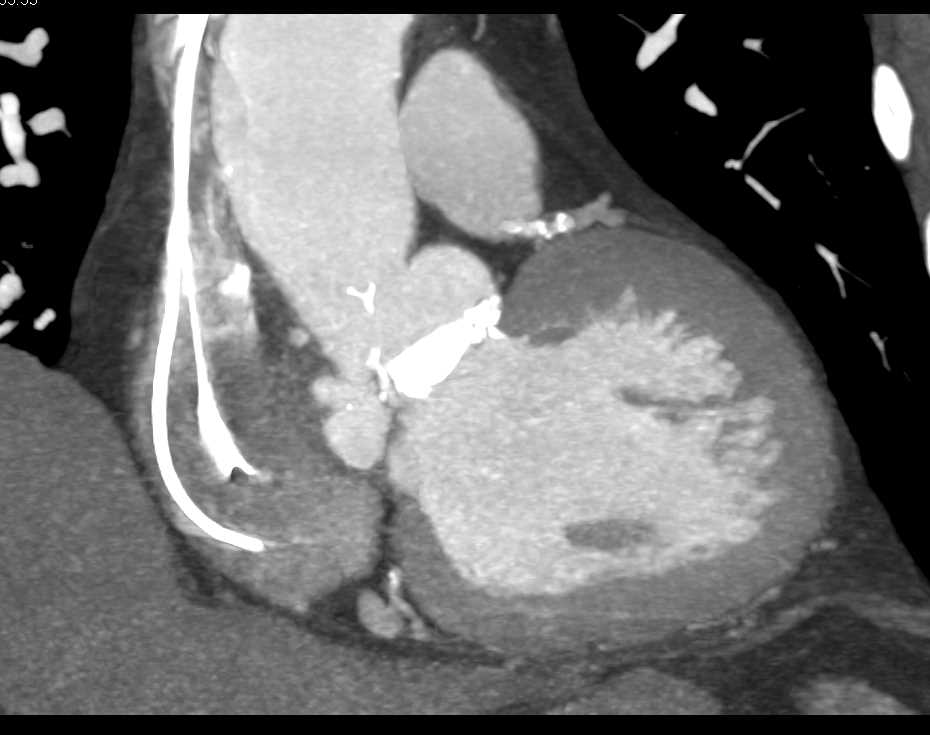 Outpouching Aortic Root near AVR - CTisus CT Scan