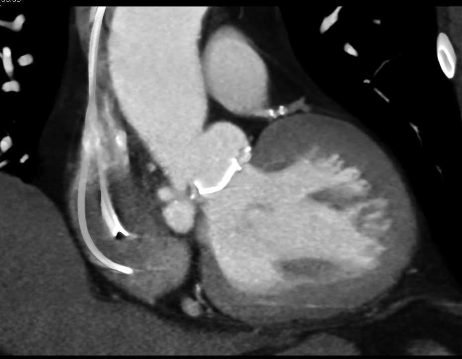 Outpouching Aortic Root near Aortic Valve Replacement (AVR) - CTisus CT Scan