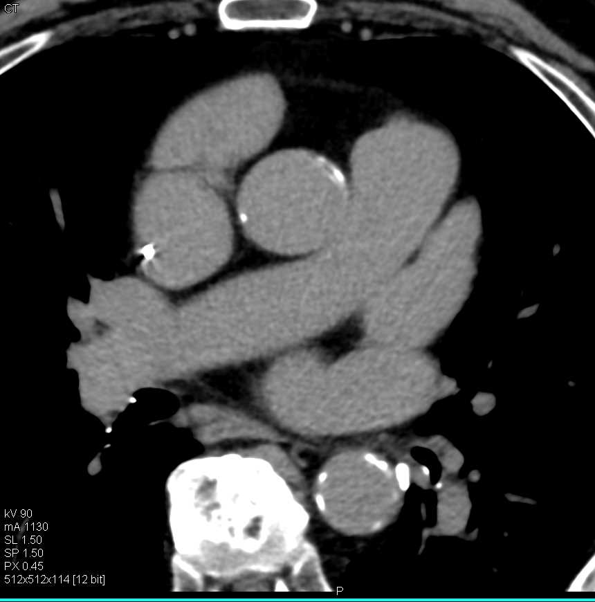 Pseudoclot in the Left Atrial Appendage - CTisus CT Scan