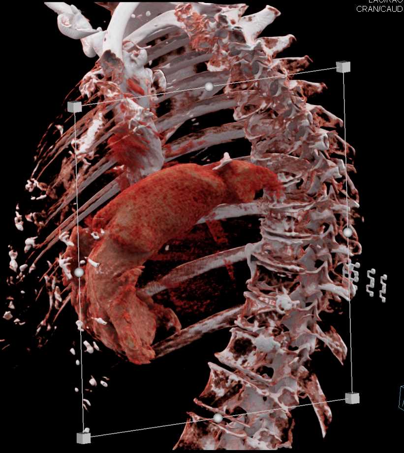 PDA with Cinematic Rendering - CTisus CT Scan