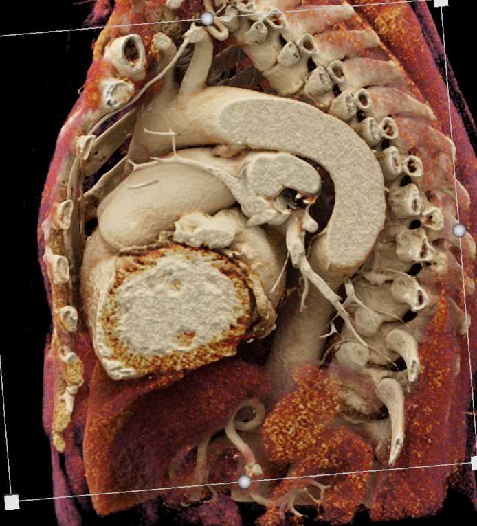 Patent Ductus Arteriosus (PDA) with Cinematic Rendering - CTisus CT Scan