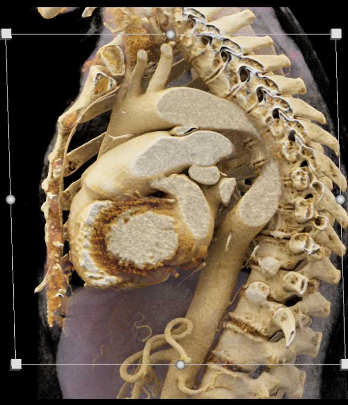 PDA (Patent Ductus Arteriosus) nicely Shown on Cinematic Rendering Plus Chest Wall Anatomy - CTisus CT Scan