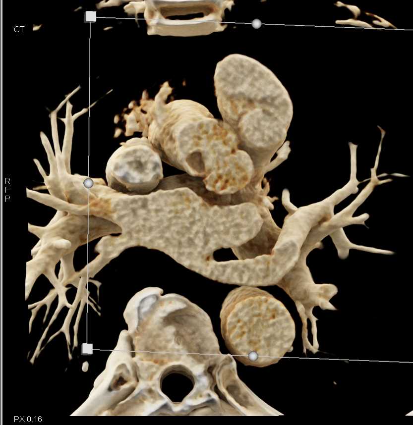 Papillary Fibroelastoma off Aortic Valve - CTisus CT Scan
