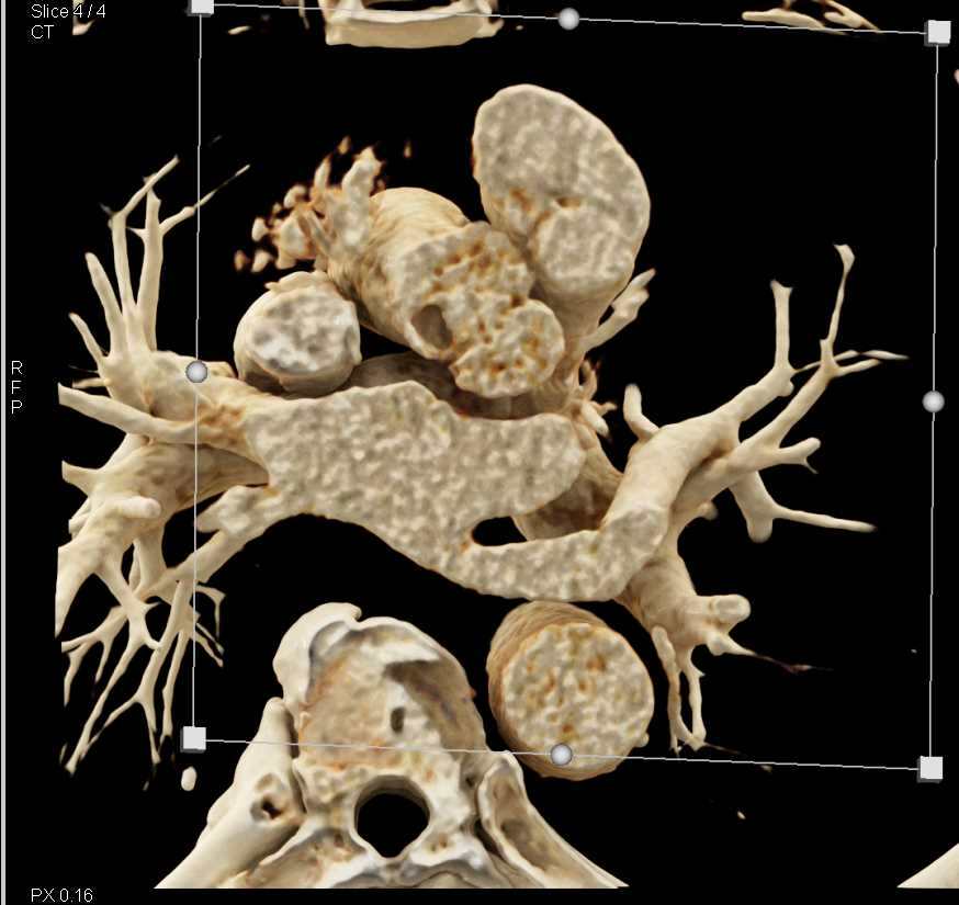 Papillary Fibroelastoma off Aortic Valve - CTisus CT Scan