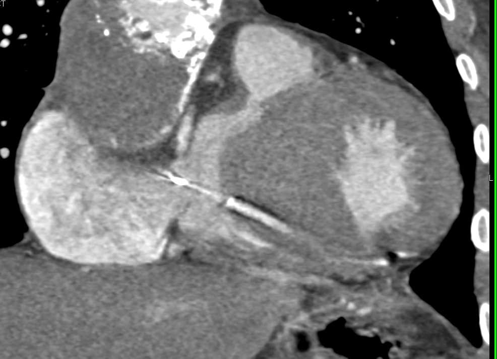 Angiosarcoma Involves the Right Side of the Heart - CTisus CT Scan