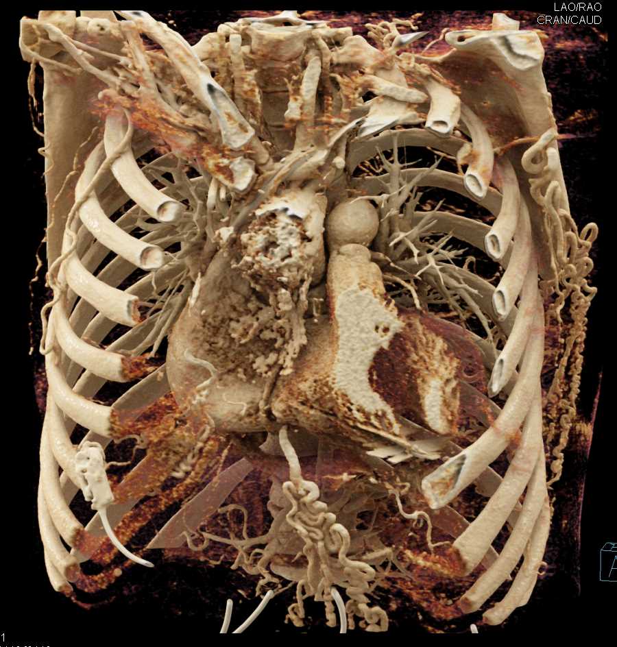 Dilated Internal Mammary Arteries with Collaterals - CTisus CT Scan