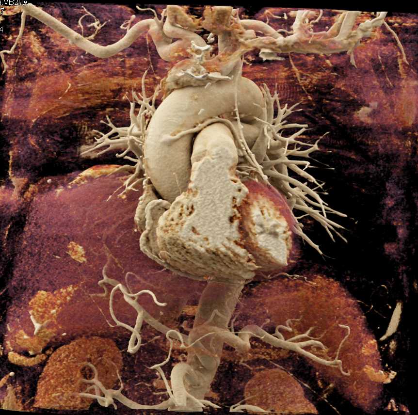 Coronary Artery Bypass Grafts - CTisus CT Scan