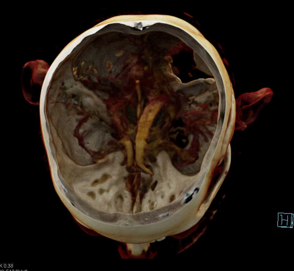 Cinematic Rendering of the Skull with Prior Surgery - CTisus CT Scan