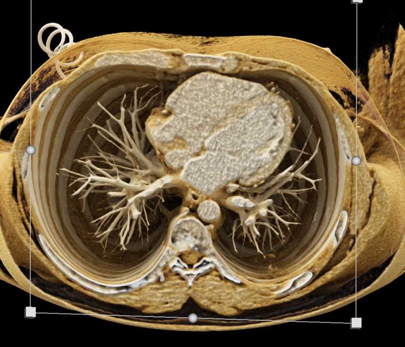 Atrial Myxoma - CTisus CT Scan