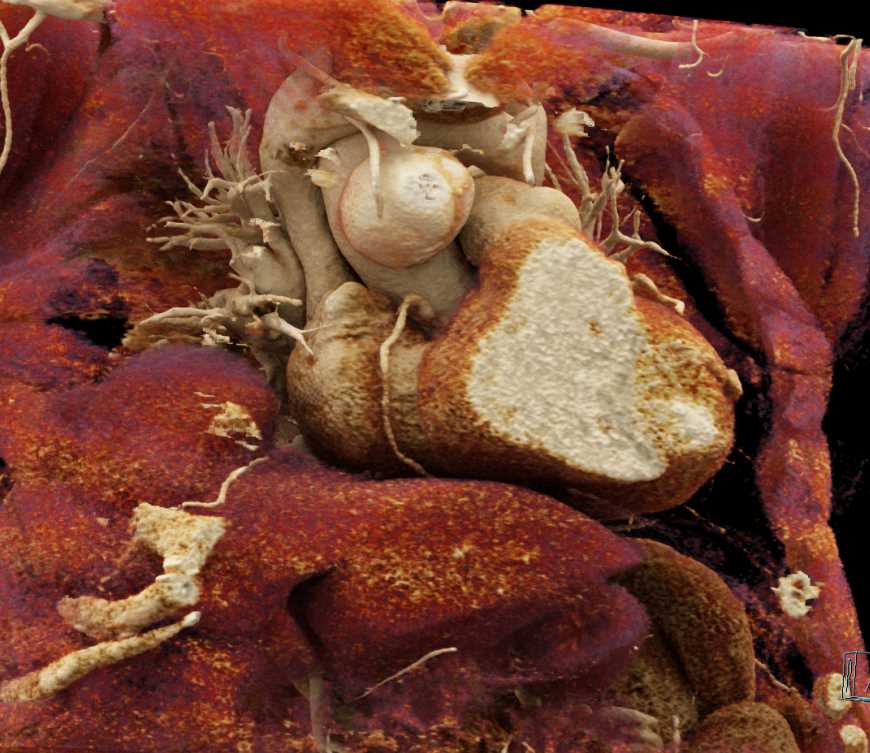 Coronary Artery Aneurysms at Coronary Artery Reimplantation Site - CTisus CT Scan