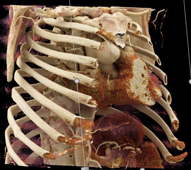 Coronary Artery Aneurysms at Coronary Artery Reimplantation Site - CTisus CT Scan