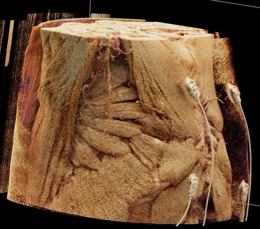 Pseudoaneurysm Ascending Aorta with Cinematic Rendering - CTisus CT Scan