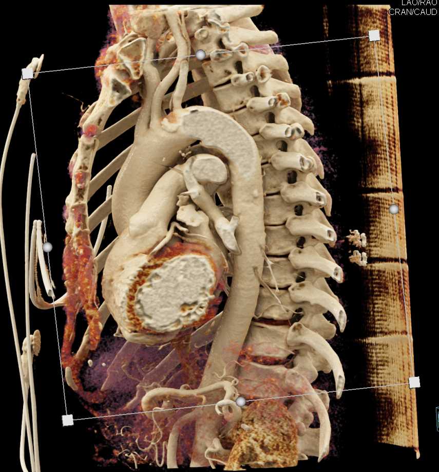 Patent Ductus Arteriosus (PDA) Nicely Seen on Cinematic Rendering - CTisus CT Scan