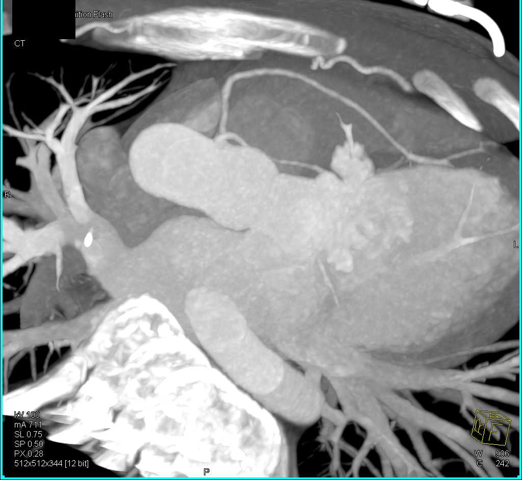 CCTA with Common Origin to Right and Left Coronary Arteries - CTisus CT Scan