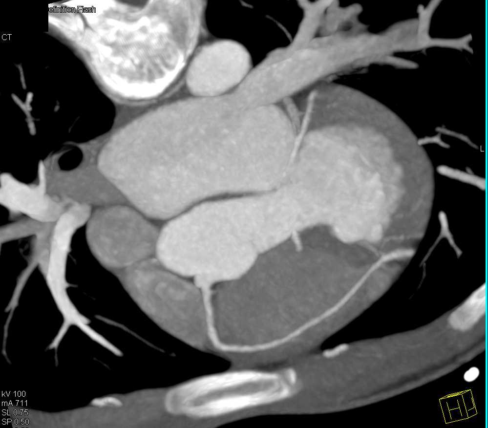 CCTA with Common Origin to Right and Left Coronary Arteries - CTisus CT Scan