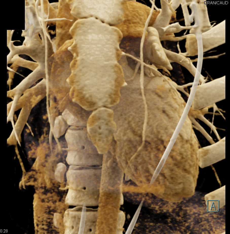 CCTA with Common Origin to Right and Left Coronary Arteries with Cinematic Rendering - CTisus CT Scan